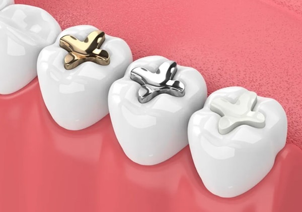 Tooth Colored Fillings In Las Vegas, NV