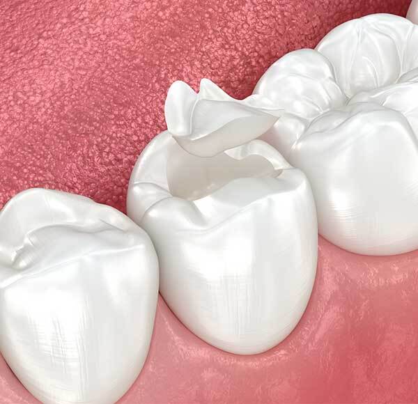 Dental sealants In Las Vegas