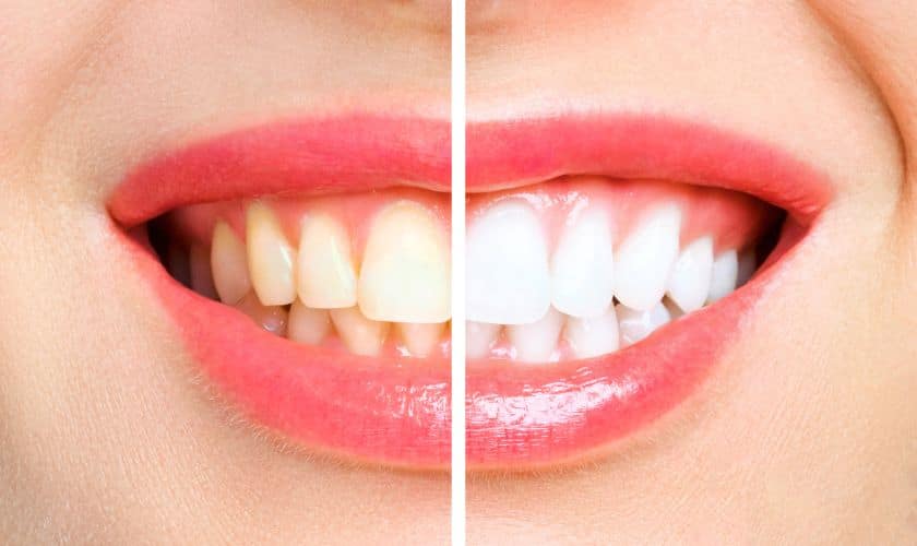 Teeth Whitening las veags