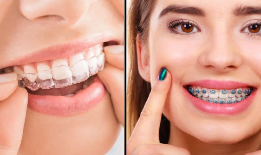 invisalign-vs-traditional-braces