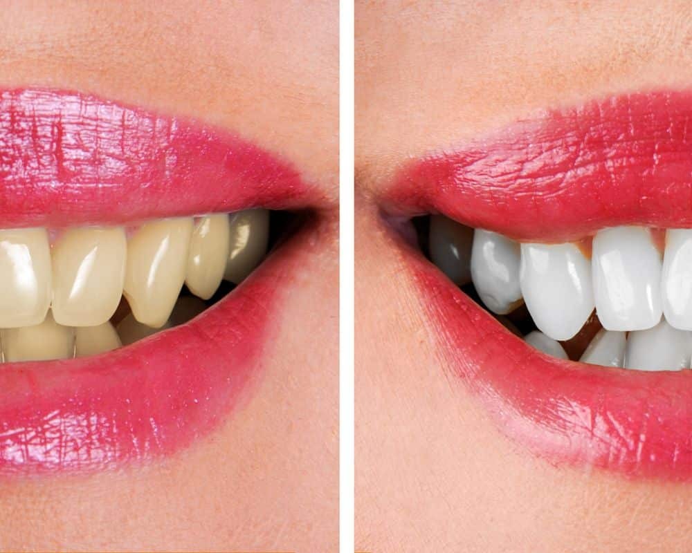 Should You Brush After Using Whitening Strips?