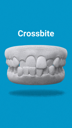 3D dental model showing crossbite malocclusion on blue background for Summerlin Smiles orthodontics.