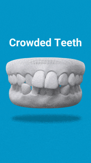 3D dental model showing crowded teeth overlapping on blue background with label