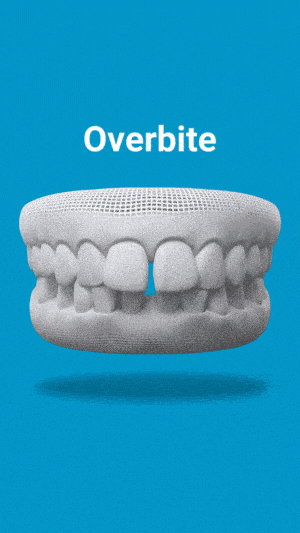 Dental model showing overbite misalignment on blue background with label text
